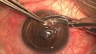 Trasplante de Cornea  Dr Abel Mauricio Martinez [upl. by Miculek642]