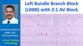 Left Bundle Branch Block LBBB with 21 AV Block [upl. by Jeffie]