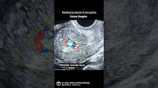 RPOC  Retained products of conception  Ultrasound and Colour Doppler [upl. by Downall274]