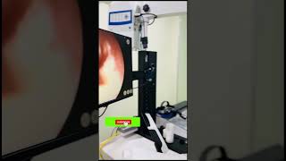 How to interpret tympanic membrane examination  DDS Traumatic perforation AOM like subscribe [upl. by Tihw]