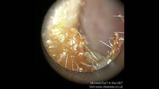 259  Sticky amp Dark Ear Wax Removal with Patient with Eustachian Tube Dysfunction using the WAXscope [upl. by Mercorr942]