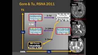 Brain Blood Clots  Imaging Hemorrhage on MR and CT [upl. by Palla190]