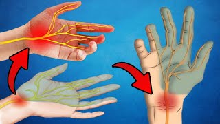 How to Fix Carpal Tunnel Without Surgery [upl. by Ahsienar650]