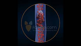 Inferior Vena Cava Filter [upl. by Netsyrk]