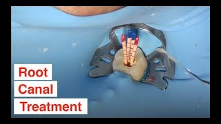 Root Canal Treatment [upl. by Nednarb]