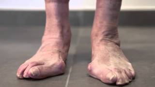 Hallux Valgus [upl. by Luanne]