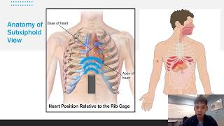 eFAST for EMS Appendix G Subxiphoid Pericardial View [upl. by Scevo]