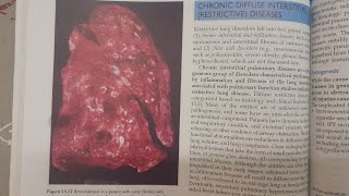 Bronchiectasis  SPECIAL PATHOLOGY [upl. by Imugem]