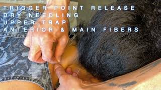 Trigger Point Release  Dry Needling Upper Trap anterior amp main fibers [upl. by Etnad]