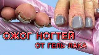 ИСПОРТИЛИ НОГТИ Больше нельзя покрывать гель лаком ⛔️ КТО В ЭТОМ ВИНОВАТ подология ожогногтей [upl. by Amalee]