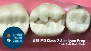 ChyuieThuth 19 MO Class 2 Amalgam Prep [upl. by Gnaoh634]