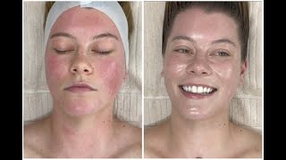 Calming Redness Blemishes amp Inflammation Facial Extractions  ASMR Meditation Jadeywadey180 [upl. by Yerffoj]