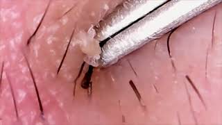 INGROWN HAIR Removal 😲 Infected Ingrown Hairs [upl. by Agarhs772]