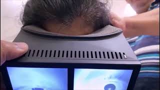 Multicanal BPPV with Canal Switch and Jam [upl. by Felecia]