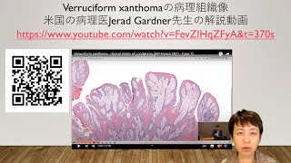 verruciform xanthomaの病理組織像 [upl. by Nnalatsyrc45]