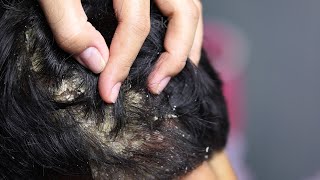 Dandruff scratching removal on head using black combing76 [upl. by Enovi]