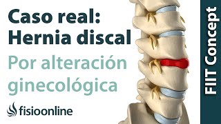 Hernia discal lumbar por una alteración ginecológica  Caso clínico real [upl. by Judi]