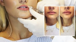 Lip Filler Experience  Start to Finish with 1 Syringe of Juvederm [upl. by Sirref466]