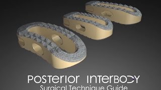 Posterior Interbody Surgical Technique Guide [upl. by Gabriele]