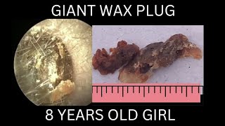 8 years old girl suffering from GIANT EARWAX PLUG [upl. by Eelta]