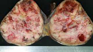 Difference Between Teratoma and Seminoma [upl. by Arbmik853]