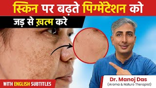 वापस कभी नहीं होगी झाइयाँ  Pigmentation Treatment at Home  Dr Manoj Das [upl. by Sibby]