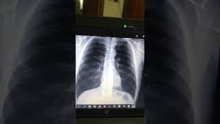 Pleural Effusion Final prof Xray interpretation [upl. by Laetitia]