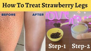 How To Treat Strawberry Legs At HomeIngrown Hair RemovalDos amp Donts To Treat Strawberry Skin [upl. by Duncan]