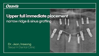 Clinical Case Upper full immediate placement on narrow ridge amp sinus grafting [upl. by Holly-Anne14]