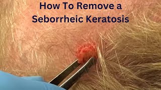 How To Remove a Seborrheic Keratosis [upl. by Camella]