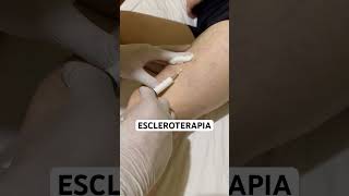 escleroterapia estetica [upl. by Chaffee]