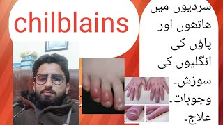 who to treat swollen fingers chilblains ibrarhussain4349 انگلیوں کی سوزش [upl. by Heppman190]