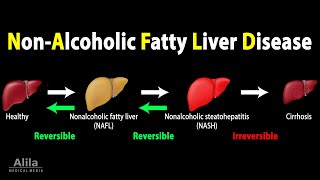 Nonalcoholic Fatty Liver Disease NAFLD Animation [upl. by Hovey]