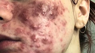 cystic acne blackhead whitehead removal  Relaxing Spa Acne Treatment [upl. by Devona]