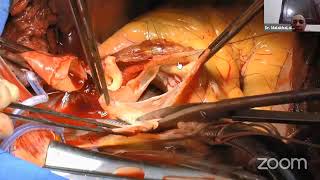 Surgery for Type A Acute Aortic Dissection Prof Dr Malakh Lal Shrestha Senior Heart Surgeon [upl. by Yajeet]