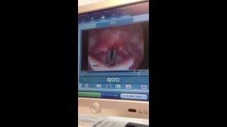 Alexs Laryngoscopy Amazing [upl. by Asim]