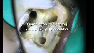 PeriodontalEndodontic considerations [upl. by Annait]