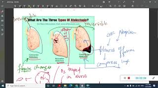 pulmonary edema  Pathology [upl. by Eanaj615]