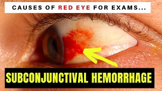 Causes of Red Eye  Part 1 SUBCONJUNCTIVAL HAEMORRHAGE blood on the eyeball [upl. by Hamlet]