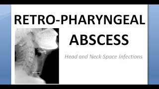 ENT Retropharyngeal Abscess Space Infection Node Rouviere Incision Drainage without anesthesia [upl. by Andrews]