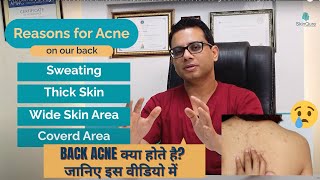 What is back acne  Causes of back acne  Body Acne  All about acne  Dr Jangid [upl. by Cassius]