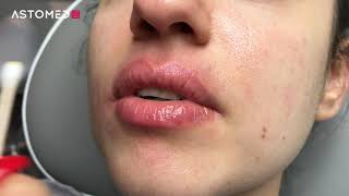 Ferulac Dubai Lips Peel  ASTOMED klinikutrustning [upl. by Jarek919]