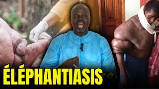 Éléphantiasis 1   Causes et Conséquences   Pr Ousmane Ndiaye  SAMA XALAAT TV [upl. by Puritan]