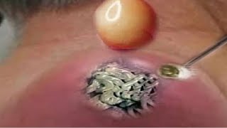 BLACKHEAD PIMPLES REMOVAL OF THE ELDERLY IN CAN THO  5016 [upl. by Ellohcin]