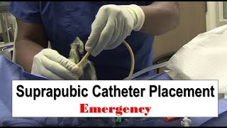 Emergency Suprapubic Catheter Placement [upl. by Ahseyd]