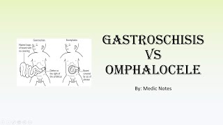 Gastroschisis vs omphalocele [upl. by Barbabas460]