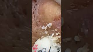 Skincare  Blackheads Removal 095 skincare skincare blackheads blackheads [upl. by Aillicec883]