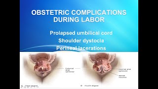 Obstetric complications during labor [upl. by Enyrhtak385]