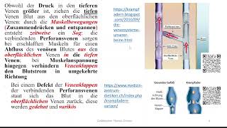 Varizen und Varikosis Teil 1 Ursachen Symptome Komplikationen Stadien nach Marshall [upl. by Nosreve]