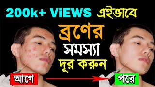 ব্রণ দূর করার উপায়  Mukher kalo dag dur korar upay  How to Remove Pimples or Acne [upl. by Etnauq]